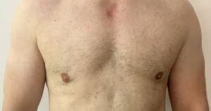 Male breast deformity after Gynecomastia Suurgery treated by Fat Transfer at Best Cosmetic Surgery Egypt