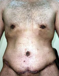 Gynecomastia Surgery and Tummy Tuck at Best Plastic surgery Egypt