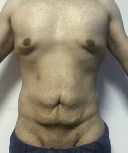 Redundant Tummy and Male Breast after Massive wight loss at Best Plastic Surgery Egypt