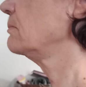 Jawline Definition, Neck lift and Tightening of Platyzma bands at Best Cosmetic Surgery Egypt