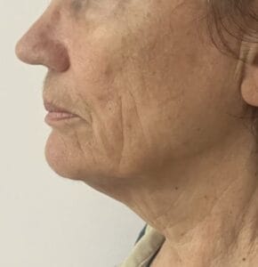 Jawline Definition, Neck lift and Tightening of Platyzma bands at Best Plastic Surgery Egypt