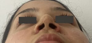 Nasal tip definition and enhanced tip Projection and narrowing of nose openings at Best Cosmetic Surgery Egypt
