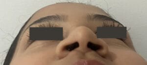 Nasal tip definition and enhanced tip Projection and narrowing of nose openings at Best Plastic Surgery Egypt