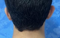 Revision ear Pinning and Otoplasty for Residual Ear Protrusion at Best Plastic Surgery Egypt