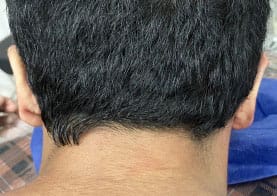Revision ear Pinning and Otoplasty for Residual Ear Protrusion at Best Cosmetic Surgery Egypt