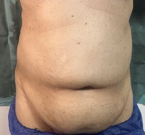 Bulging overhanging tummy and rounded waist for High Definition Smart Vaser Liposculpture at Best Plastic surgery Egypt