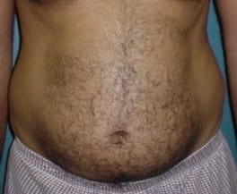 Bulging overhanging tummy and rounded waist for High Definition Smart Vaser Liposculpture at Best Cosmetic surgery Egypt