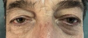 Sagging Eyelid skin and Eyebags for upper and Lower Eyelid Lift at Best Plastic Surgery Egypt