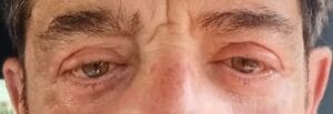 Sagging Eyelid skin and Eyebags for upper and Lower Eyelid Lift at Best Cosmetic Surgery Egypt