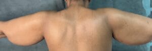 Brachioplasty Arm Lift and simultaneous Vaser Liposuction for Arm Lipedema at Best Plastic Surgery Egypt