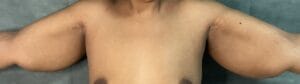 Brachioplasty Arm Lift and simultaneous Vaser Liposuction for Arm Lipedema at Best Aesthetic Surgery Egypt