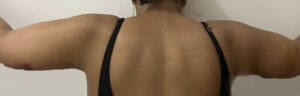 Brachioplasty Arm Lift and simultaneous Vaser Liposuction for Arm Lipedema at Best Cosmetic Surgery Egypt