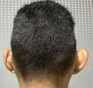 Protruding and cupping ears with asymmetry and projection for Otoplasty at Best Plastic Surgery Egypt