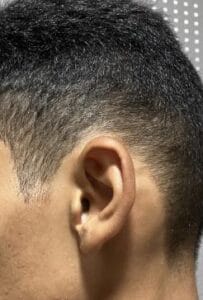 Protruding and cupping ears with asymmetry and projection for Otoplasty at Best Aesthetic Surgery Egypt