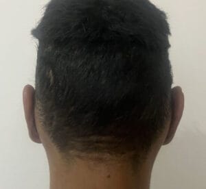 Protruding and cupping ears with asymmetry and projection for Otoplasty at Best Cosmetic Surgery Egypt