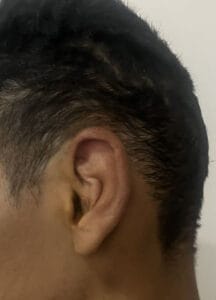 Protruding and cupping ears with asymmetry and projection for Ear Pinning and Reduction at Best Plastic Surgery Egypt