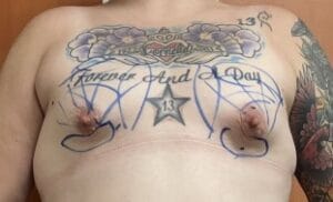 Fat Transfer for Deformed Breast with flat shape and Mastopexy at Best Plastic Surgery Egypt