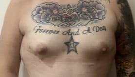 Fat Transfer for Deformed Breast with flat shape and Mastopexy at Best Cosmetic Surgery Egypt
