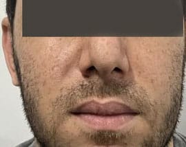 Buccal Fat removal for enhanced Face contour and Cheek definition at Best Cosmetic Surgery Egypt