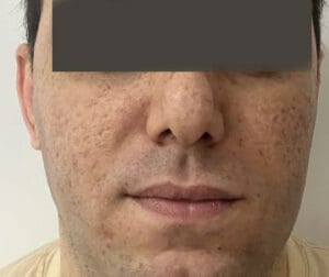 Buccal Fat removal for enhanced Face contour and Cheek definition at Best Plastic Surgery Egypt