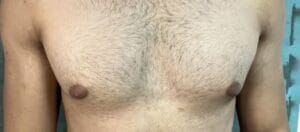 Grade 1 Gynecomastia with only a disc treated by breast surgery at Best Plastic Surgery Egypt