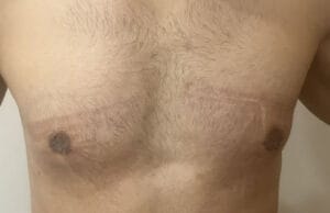 Grade 1 Gynecomastia with only a disc treated by breast surgery at Best Cosmetic Surgery Egypt