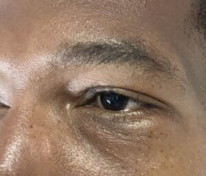Bags in the lower eyelid treated by Lower Eyelid Lift Blepharoplasty at Best Plastic Surgery Egypt