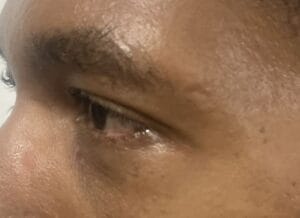 Bags in the lower eyelid treated by Lower Eyelid Lift Blepharoplasty at Best Cosmetic Surgery Egypt
