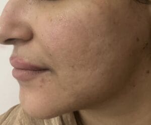 Stem Cells and Nanofat to treat face scars and pits at Best Plastic Surgery Egypt