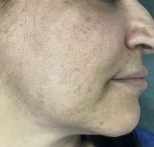 Skin scars and pits treated by nano fat grafting and stem cells at best Plastic Surgery Egypt