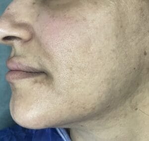 Stem Cells and Nanofat to treat face scars and pits at Best Cosmetic Surgery Egypt