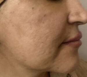 Skin scars and pits treated by nano fat grafting and stem cells at best Cosmetic Surgery Egypt