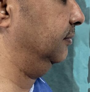 Neck Liposuction and Lifting for extra skin and extra fat in the neck and platyzma at Best Plastic Surgery Egypt