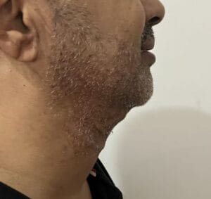 Neck Liposuction and Lifting for extra skin and extra fat in the neck and platyzma at Best Cosmetic Surgery Egypt