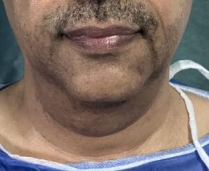 Neck Liposuction and Lifting for extra skin and extra fat in the neck and platyzma at Best Aesthetic Surgery Egypt