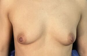 Dual plane Breast augmentation Enlargement at Best Plastic Surgery Egypt