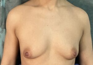 Hybrid Breast augmentation using silicon implants and Fat Grafting for Best Cleavage at Best Plastic Surgery Egypt