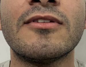 Chin and jawline Silicon implants for pointed chin at Best Cosmetic Surgery Egypt