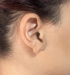 Embedded Ear Keloid after Ear Piercing treated by resection and 5-Flurouracil at Best Plastic Surgery Egypt