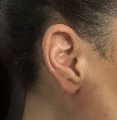 Embedded Ear Keloid after Ear Piercing treated by resection and 5-Flurouracil at Best Cosmetic Surgery Egypt