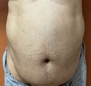 High Definition Liposculpture with Muscle Tightening and Exercising and Tai Chi walking at Best Plastic Surgery Egypt