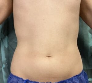 High Definition Liposculpture with Muscle Tightening and Exercising and Tai Chi walking at Best Cosmetic Surgery Egypt