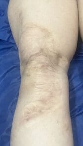 Tissue Expander by Silicon Balloon after Burn Scar in Leg at Best Plastic Surgery Egypt