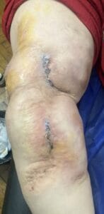 Tissue Expander by Silicon Balloon after Burn Scar in Leg at Best Cosmetic Surgery Egypt