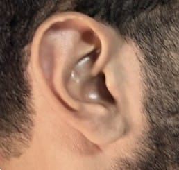 Long Ear reduction by wedge excision at Best Plastic Surgery Egypt