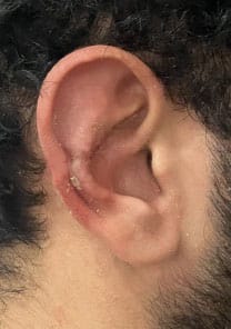 Long Ear reduction by wedge excision at Best Cosmetic Surgery Egypt