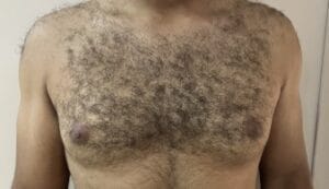 Hormonal Male Breast Gynecomastia treated by disc removal and Smart Vaser Liposuction at Best Plastic Surgery Egypt
