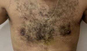 Hormonal Male Breast Gynecomastia treated by disc removal and Smart Vaser Liposuction at Best Cosmetic Surgery Egypt