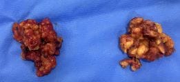 Hormonal Male Breast Gynecomastia treated by disc removal and Smart Vaser Liposuction at Best Aesthetic Surgery Egypt