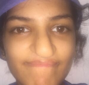 Secondary Nose Job Rhinoplasty after Cleft Lip Nose and Fat Grafting at Best Plastic surgery Egypt